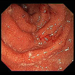 воспаление кишечника обнаруженные при колоноскопии